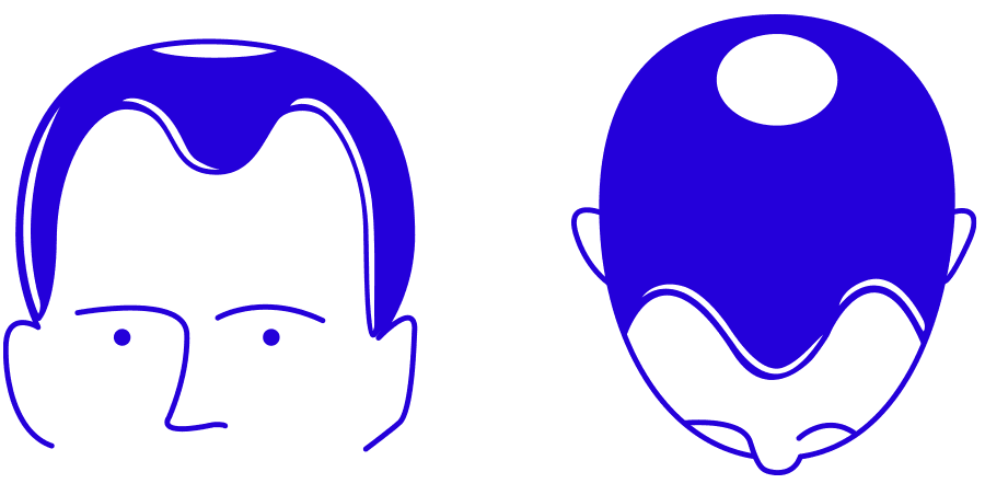hair loss image